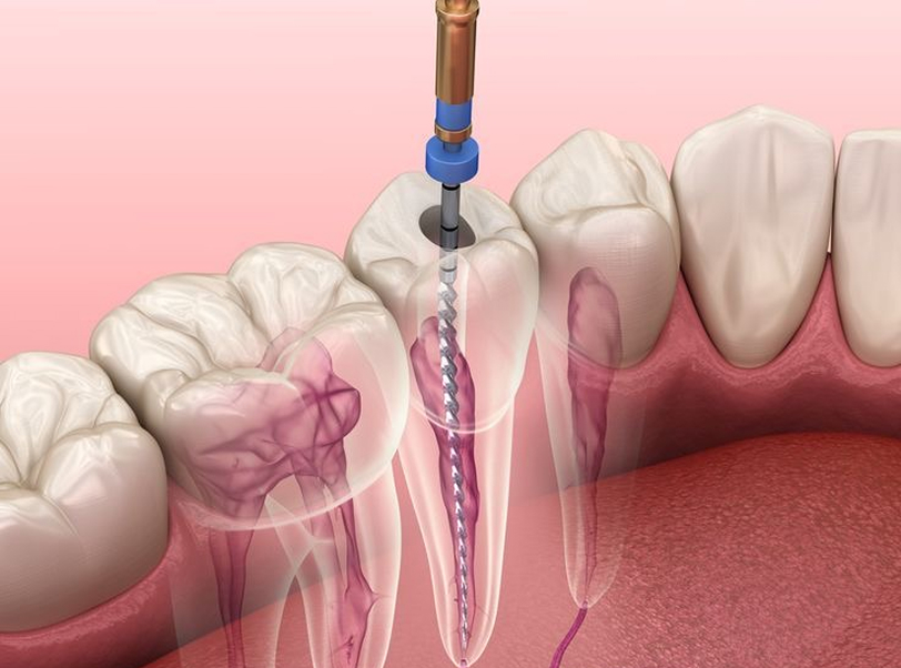 Endodontia - 1
