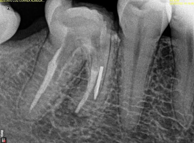 Endodontia - 2