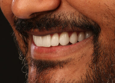 Facetas e lentes de contato - 3