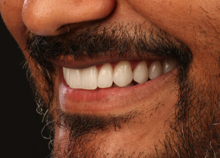 Facetas e lentes de contato - 3