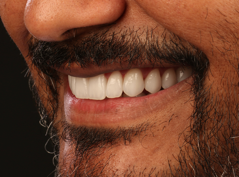 Facetas e lentes de contato - 3