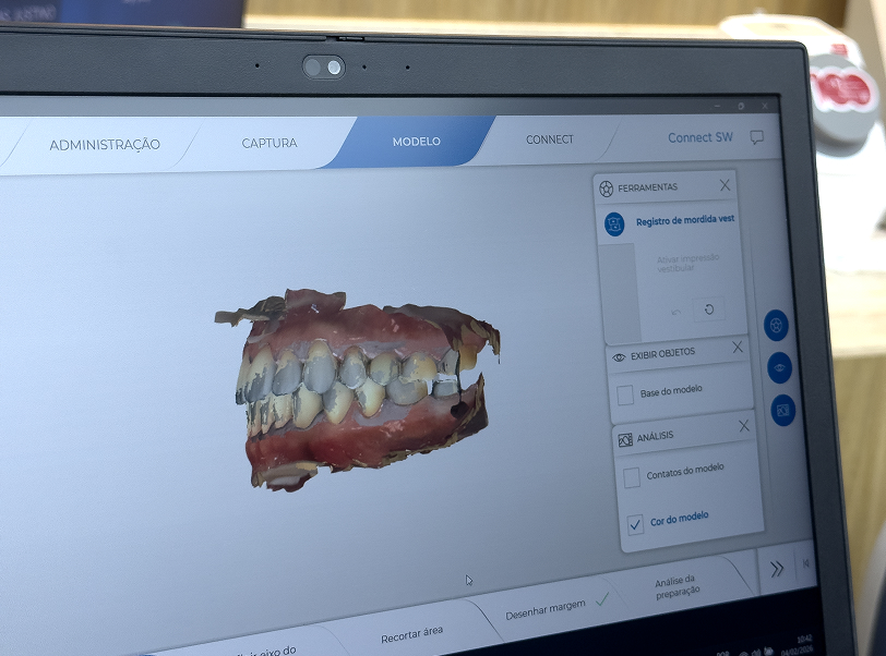 Facetas e lentes de contato - 4