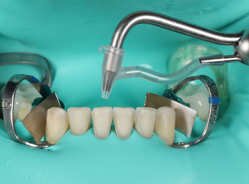 Facetas e lentes de contato - 5