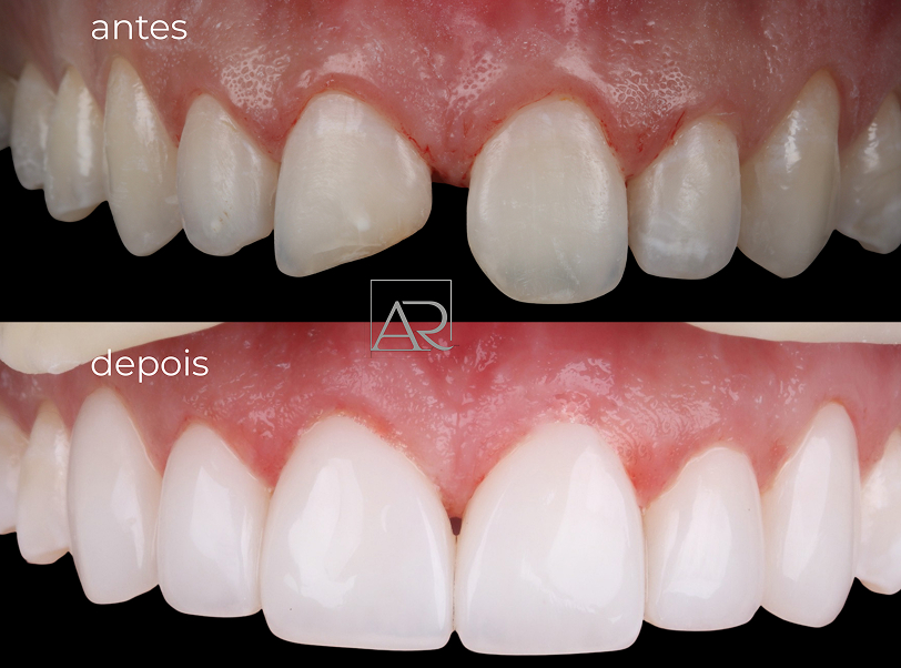 Facetas e lentes de contato - 8