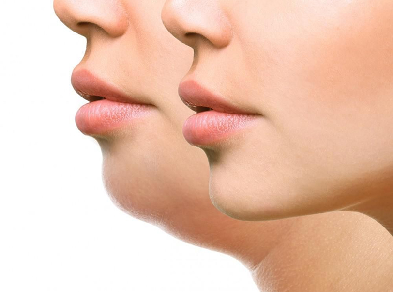 Harmonização Orofacial - 2