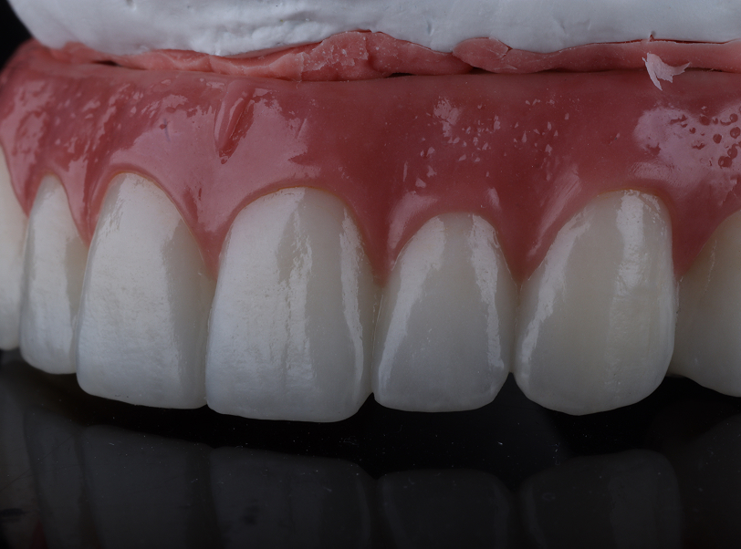 Prótese sobre implante - 4