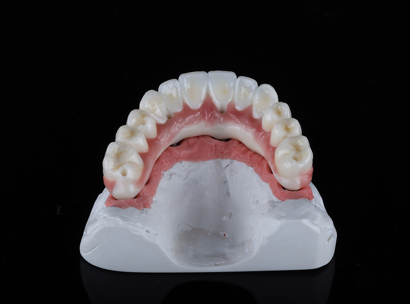 Prótese sobre implante - 5