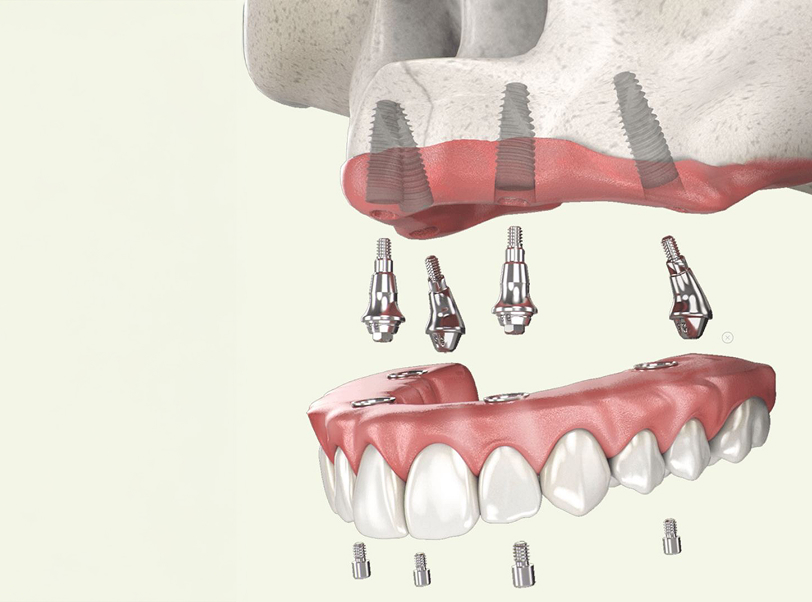 Prótese sobre implante - 6